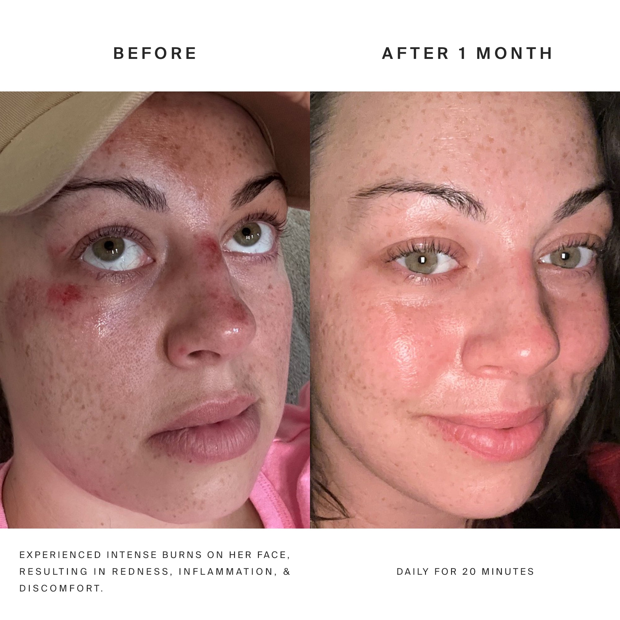 Higherdose Red Light Face Mask