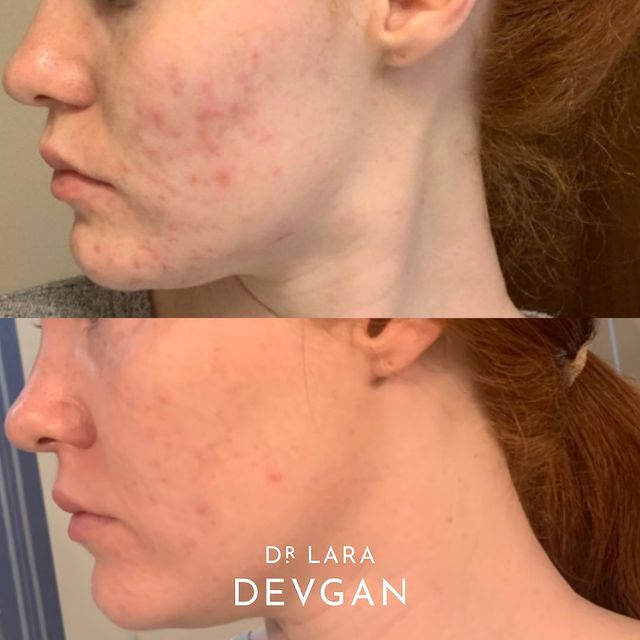 Real Client Stories: Minimalist Acne Treatment